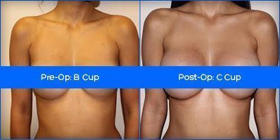 Gynecomastia (Male Breast Reduction) Pictures of a Male patient by ...