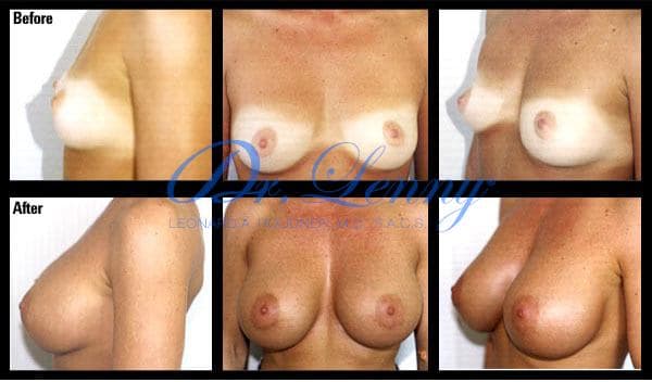 Breast Augmentation before and after, Case 11