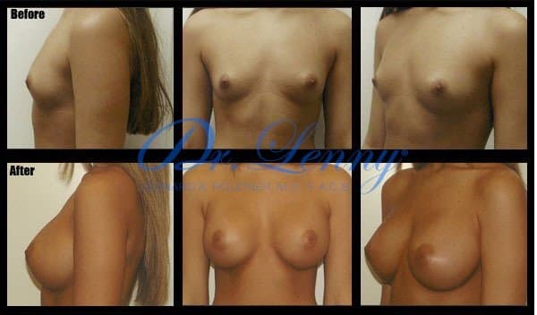 Breast Augmentation before and after, Case 13
