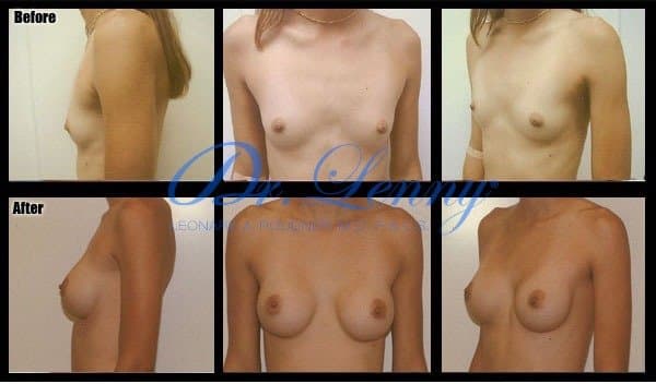 Breast Augmentation before and after, Case 14