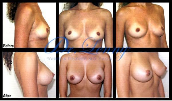 Breast Augmentation before and after, Case 16