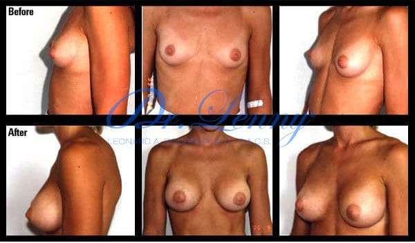 Breast Augmentation before and after, Case 19