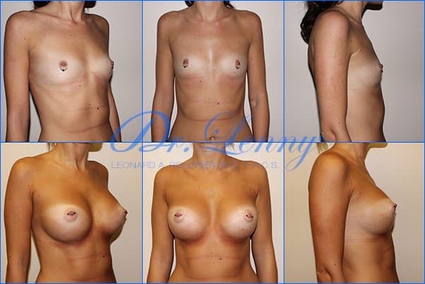 Breast Augmentation before and after, Case 02