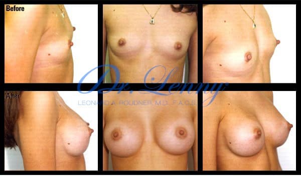 Breast Augmentation before and after, Case 05