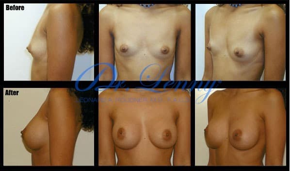 Breast Augmentation before and after, Case 09