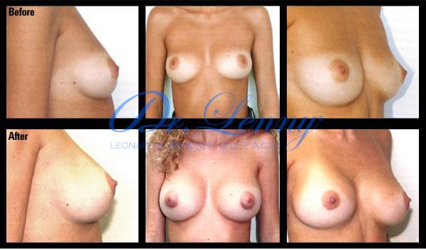 Miami Breast Augmentation Before After Photo