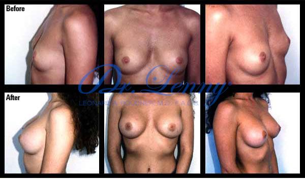 Miami Breast Augmentation Before After Photo
