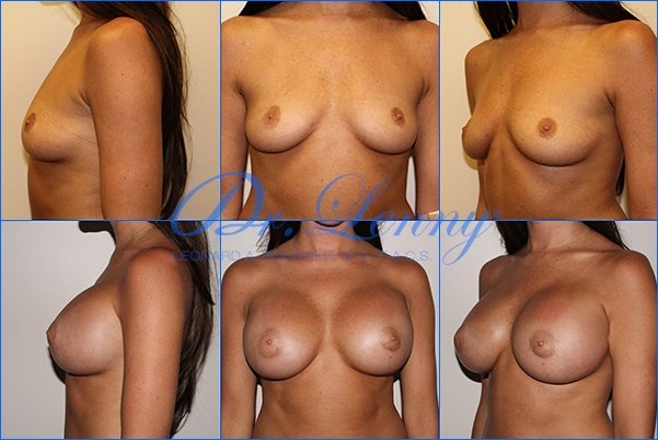 Breast Augmentation Before and After Photo
