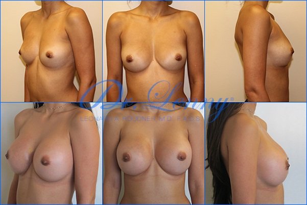 Breast Augmentation Before and After Photo